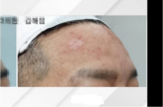 시술 후
