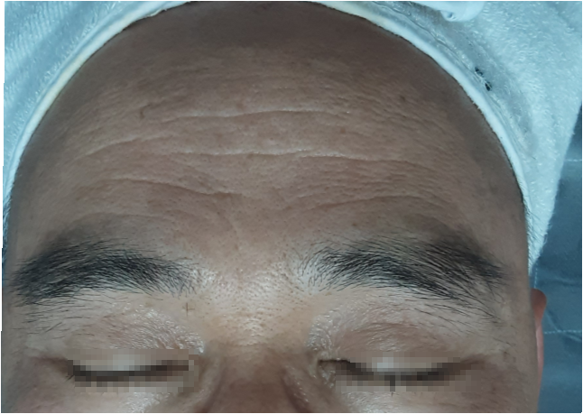 시술 전