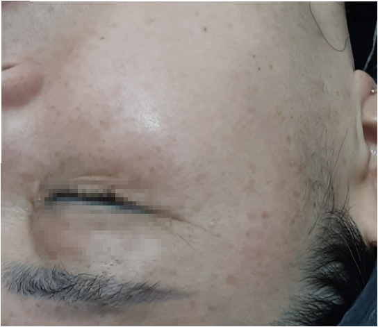 시술 후
