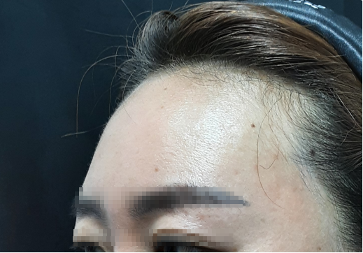 시술 후