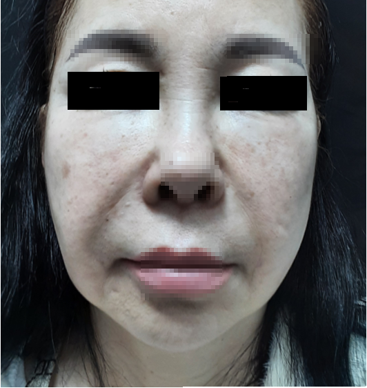 시술 전