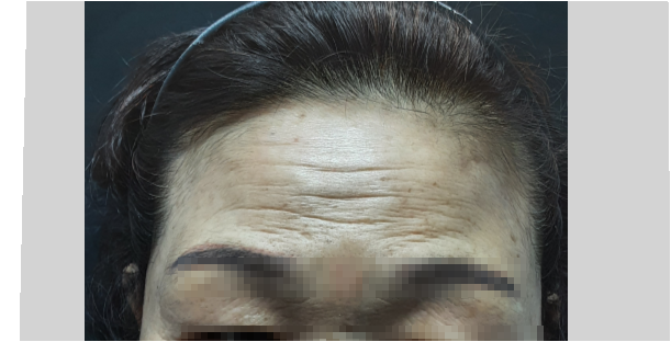 시술 전